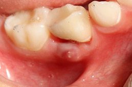 Abscessed tooth