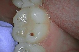Dental cavity