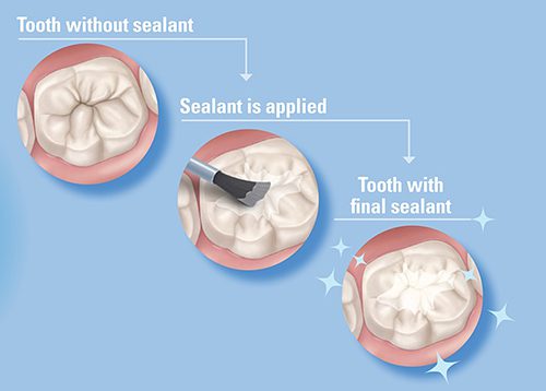 Dental Sealants graphic