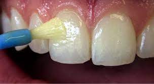 Dental Fluoride Treatment
